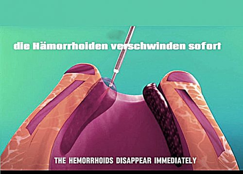 LHPC - Laser Haemorrhoiden Therapie