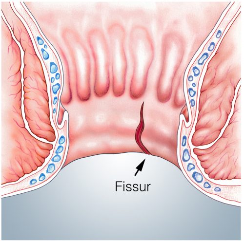 Analfissur