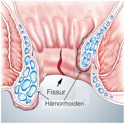 Analriss wegen Haemorrhoiden